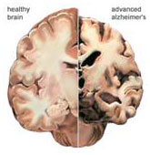 alzheimers-brain.jpg