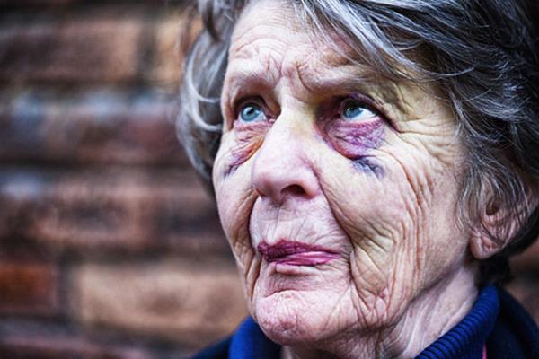Senior woman with a black eye due to senior abuse.